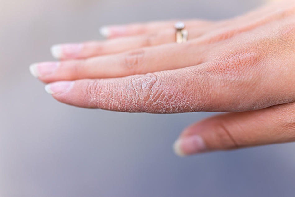 Woman examining rough dry skin patches on hands showing flaking texture and moisture barrier damage close-up view Close-up detailed view of woman's hands showing rough, dry, flaky skin texture with visible moisture barrier damage and uncomfortable tightness requiring intensive moisturizing treatment and gentle skincare routine - InfoProds 2026 beauty health guide