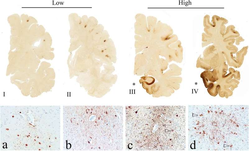 Neuropathologist Examining Brain Tissue for CTE Tau Protein Evidence Medical researcher examining brain tissue samples under microscope searching for tau protein deposits and neurofibrillary tangles characteristic of chronic traumatic encephalopathy in former football players, representing groundbreaking neuropathology research revealing 92 percent CTE occurrence rate among studied NFL athletes - InfoProds Medical Science Investigation 2026