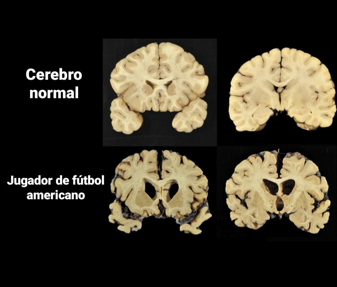 Boston University CTE Research Center Brain Bank Specimens Collection Research laboratory showing brain specimen storage and analysis equipment at Boston University CTE Center where scientists have diagnosed chronic traumatic encephalopathy in 345 of 376 former NFL players studied, revealing shocking prevalence of football-related brain damage through systematic post-mortem tissue examination - InfoProds Neuroscience Research 2026