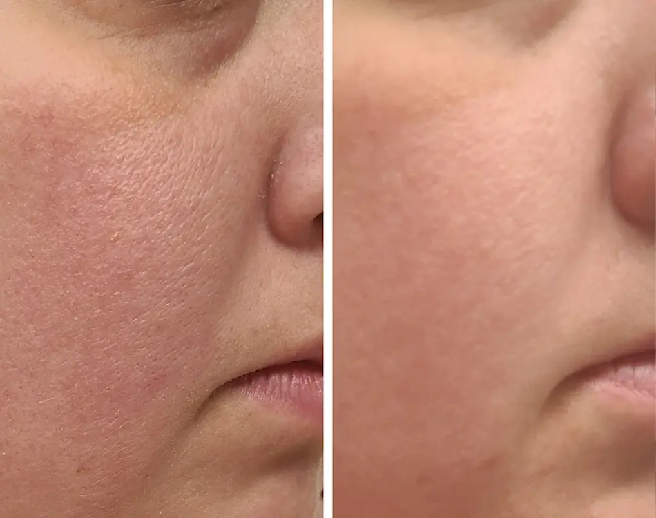 Dramatic before and after comparison photographs taken three to six months apart showing visible improvements in fine lines wrinkles skin texture tone evenness and overall radiance achieved through consistent dermatologist-approved skin cycling routine with retinoids and chemical exfoliants - InfoProds Real Results 2026