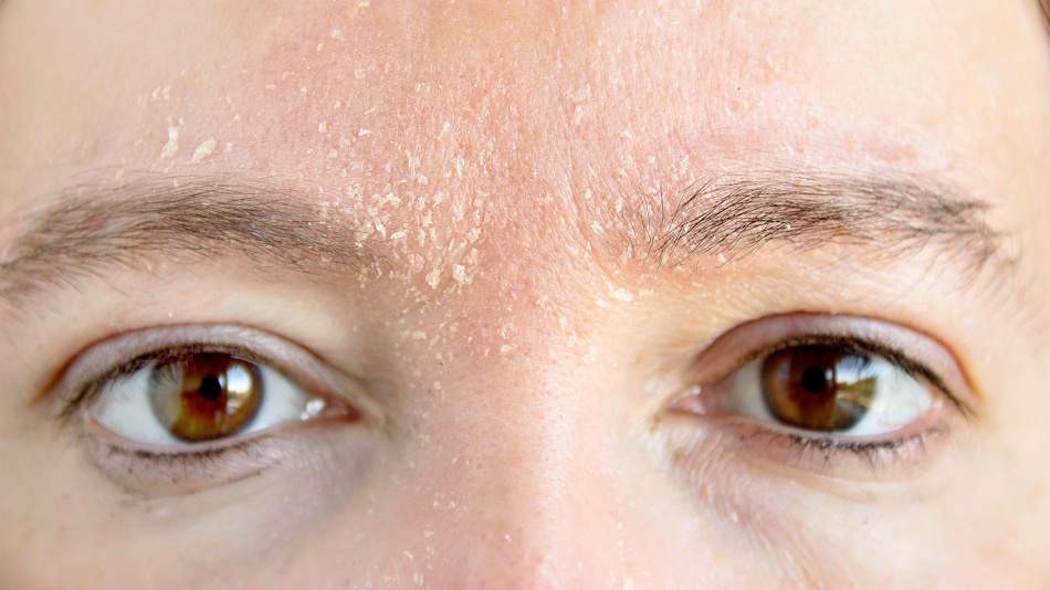Winter Dry Skin Damaged Face Close-up Scientific View Close-up of winter-damaged dry flaky facial skin showing effects of cold weather and improper skincare products - InfoProds dermatology guide 2026