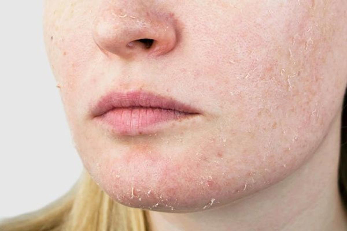 Winter Skin Crisis: The $200 Beauty Mistake Destroying Your Face (and Body)